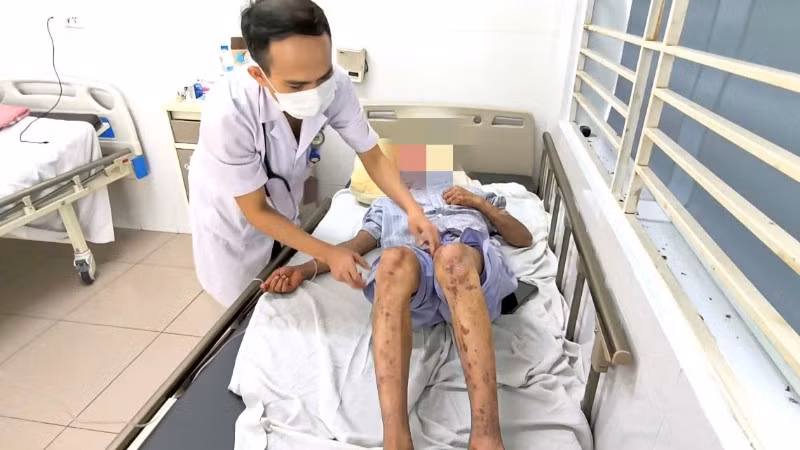 Bệnh nhân rơi vào tình trạng mù tạm thời. 