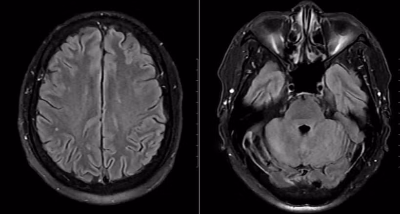 Hình ảnh chụp tổn thương não của bệnh nhân.