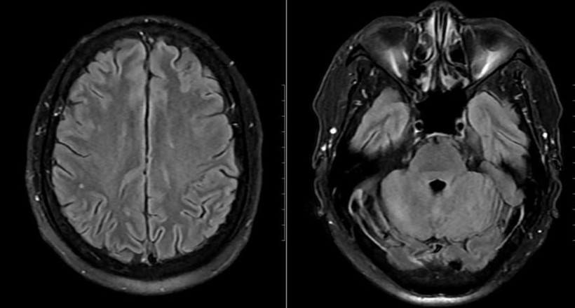 Hình ảnh chụp tổn thương não của bệnh nhân.