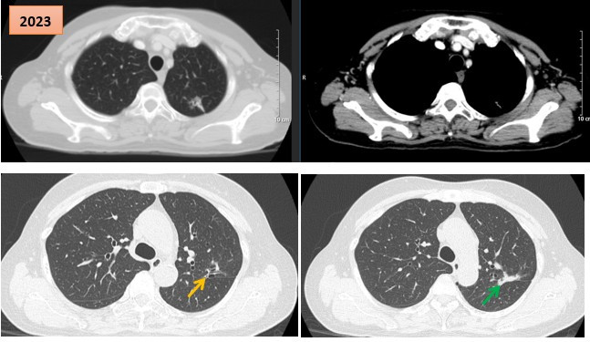 Hình ảnh cắt lớp vi tính theo dõi trong quá trình điều trị, tổn thương xơ hóa tại vị trí u cũ (mũi tên xanh) và giãn khu trú các nhánh phế quản liền kề (mũi tên vàng).