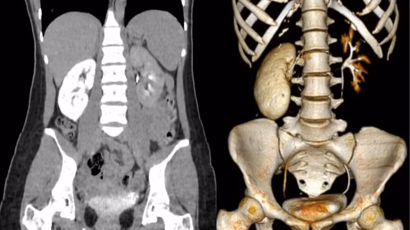 Thận bệnh nhân 18 tuổi gần như "hóa đá". (Ảnh: Bác sĩ cung cấp)