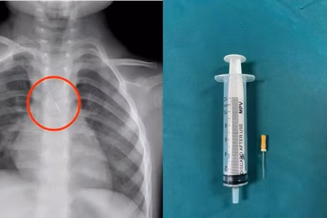 Dị vật trong đường thở của bệnh nhi. (Ảnh: Bệnh viện Đa khoa tỉnh Quảng Trị)