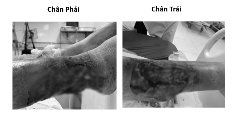 Bệnh nhân nữ nhập viện trong tình trạng tổn thương lóc da vùng cẳng chân hai bên do tai nạn giao thông, vết thương có nguy cơ hoại tử. (Ảnh: BVCC)
