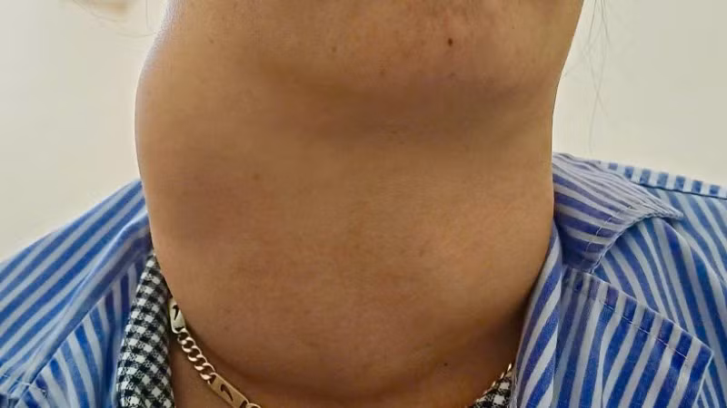 Ca bướu giáp khổng lồ ở bệnh nhân 41 tuổi.