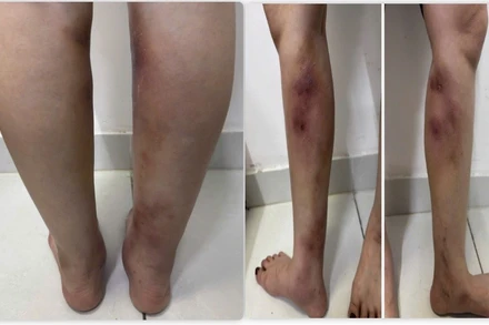 Hình ảnh tổn thương của người bệnh. 