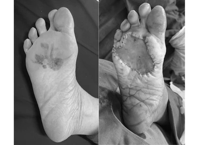 Bệnh nhân ung thư tế bào hắc tố gan chân trước và sau phẫu thuật. (Ảnh: BVCC)