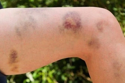 Vết bầm tím trên cơ thể là một trong những dấu hiệu của bệnh TTP.