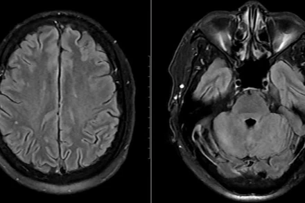 Hình ảnh chụp tổn thương não của bệnh nhân.