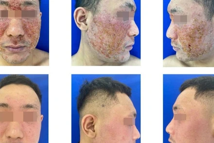 Viêm da tiếp xúc dị ứng vùng mặt, làm thế nào để phòng tránh?