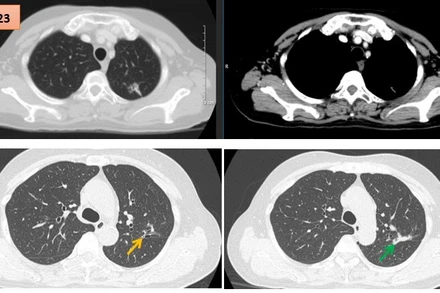 Hình ảnh cắt lớp vi tính theo dõi trong quá trình điều trị, tổn thương xơ hóa tại vị trí u cũ (mũi tên xanh) và giãn khu trú các nhánh phế quản liền kề (mũi tên vàng).