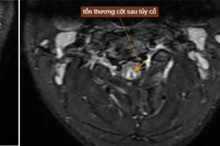 Tổn thương của nam thanh niên sau khi hút bóng cười. 