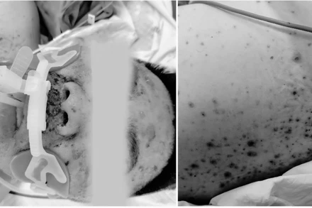 Bệnh nhân suy đa phủ tạng vì mắc thủy đậu. 