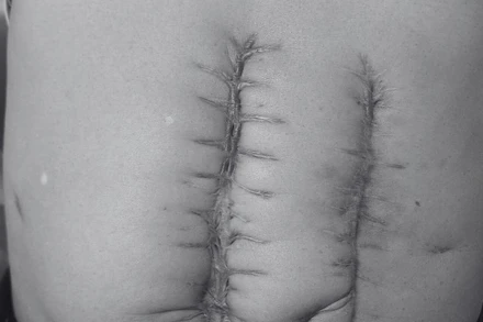 Vết sẹo mổ hoại tử ruột của bệnh nhân. 