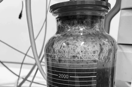 Hơn 2 lít dịch được hút ra từ ngực cô gái đã nâng ngực 5 năm trước. (Ảnh: BVCC)