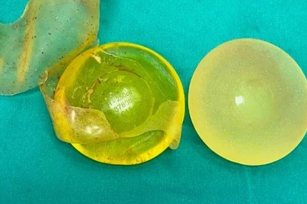 Túi ngực sau phẫu thuật tháo bỏ. 