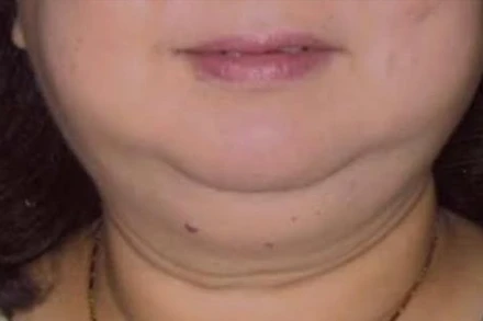 Bệnh nhân có mặt tròn, tăng cân bất thường do suy tuyến thượng thận. 