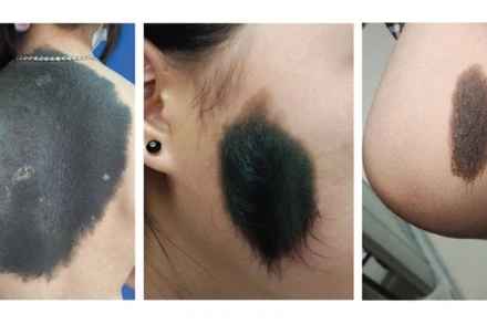 Hình ảnh nơ vi hắc tố bẩm sinh (Cơ quan y tế cung cấp).