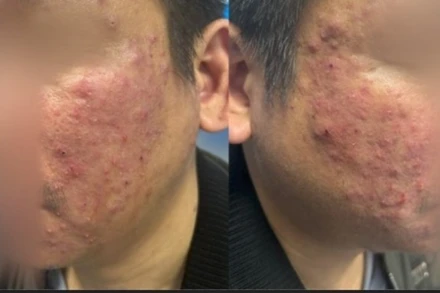 Viêm da mặt kéo dài, người bệnh bất ngờ phát hiện nhiễm ký sinh trùng Demodex