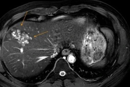 Hình ảnh tổn thương do sán lá gan. 