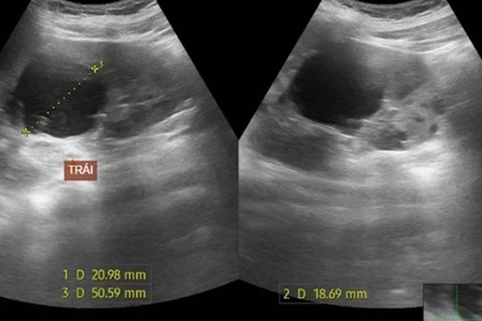 Hình ảnh siêu âm nang thận của bệnh nhân. 