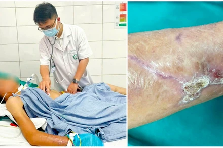 Bệnh nhân nằm điều trị tại Bệnh viện Bạch Mai do uốn ván. 