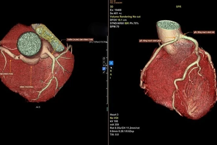 Hình ảnh chụp CTA 3D. Bên trái là động mạch vành bình thường. Bên phải là hình ảnh hai nhánh động mạch vành trái và phải xuất phát chung từ một gốc.