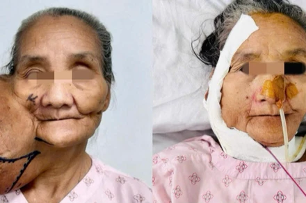 Bệnh nhân đã được phẫu thuật loại bỏ khối u khổng lồ. 