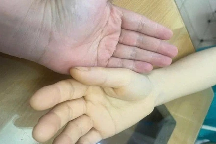 Bàn tay bệnh nhân (bên phải) vàng da vì mất máu. 