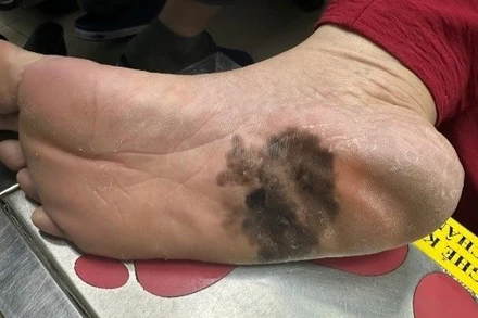 Hình ảnh ung thư tế bào hắc tố của bệnh nhân hơn 60 tuổi.