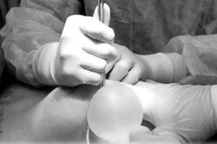 Các bác sĩ thực hiện phẫu thuật hút dịch mủ ngực cho bệnh nhân.