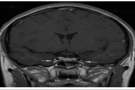 Vị trí mũi tên là viêm và co thắt động mạch cảnh trong 2 bên.