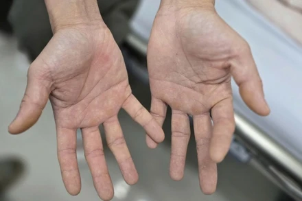 Bàn tay của anh H. bị tê bì, không thể khép lại và mất cảm giác.