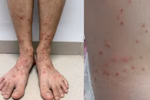 Hình ảnh sẩn ngứa do bọ chét.