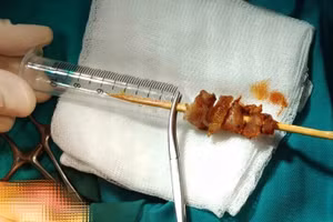 Dị vật gây tổn thương nghiêm trọng cho cháu bé. 