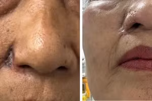 Hình ảnh trước và sau khi phẫu thuật loại bỏ khối u, phục hình cánh mũi cho bệnh nhân.
