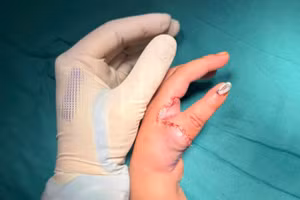Bàn tay bệnh nhi sau khi được phẫu thuật tái tạo ngón cái. 