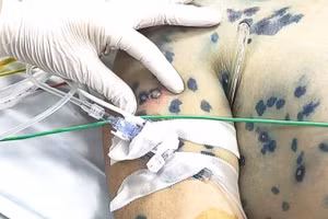 Ca bệnh mắc thủy đậu nằm điều trị tại Bệnh viện Bệnh Nhiệt đới Trung ương đặc biệt phức tạp khi bệnh truyền nhiễm bùng phát đồng thời với biến chứng ngoại khoa và nhiễm trùng huyết.