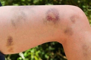 Vết bầm tím trên cơ thể là một trong những dấu hiệu của bệnh TTP.