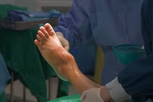 Khối u âm thầm phá hủy đến 80% thể tích xương sên của người bệnh, gây ra những cơn đau đầy ám ảnh.