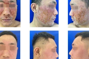 Viêm da tiếp xúc dị ứng vùng mặt, làm thế nào để phòng tránh?