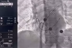 Hình ảnh catheter triệt đốt trong buồng tim, phát xung điện cô lập tĩnh mạch phổi.