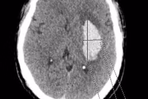 Ổ tổn thương não do đột quỵ.
