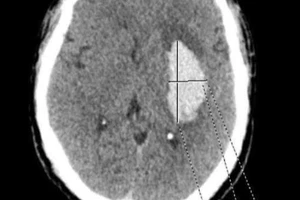 Ổ tổn thương não do đột quỵ.