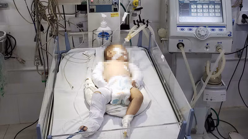 Bé gái đang được điều trị tích cực tại Bệnh viện đa khoa tỉnh Lâm Đồng.