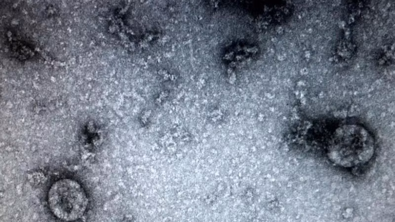 Các nhà nghiên cứu từ Đại học Y khoa Sechenov của Nga cảnh báo những người từng bị nhiễm virus SARS-CoV-2 đều có thể mắc một căn bệnh nguy hiểm: Hoại tử xương. (Ảnh: TTXVN)