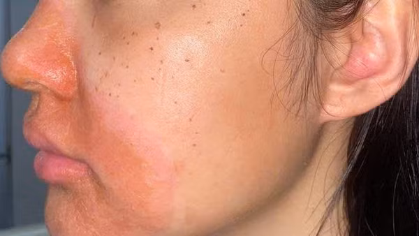 Một trường hợp viêm da sau thực hiện các thủ thuật làm đẹp tại spa.