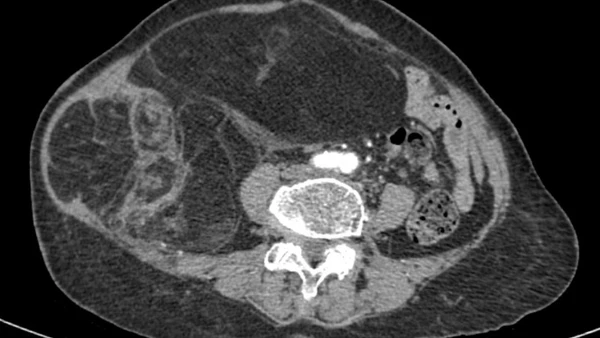 Hình ảnh phim chụp CT ổ bụng của người bệnh.