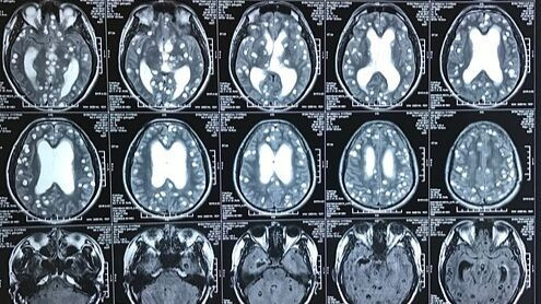 Ảnh minh họa tổn thương não do ổ sán não. 