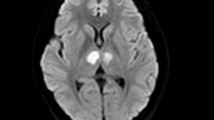 Phim chụp cho thấy não bệnh nhân bị tổn thương vùng đồi thị hai bên.
