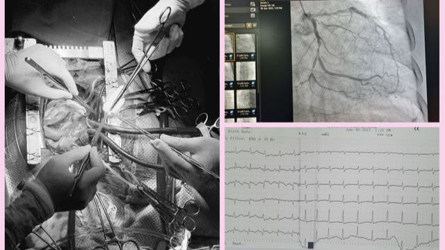 Nhồi máu cơ tim gây biến chứng thủng vách liên thất